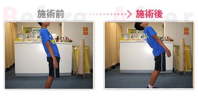 【安城整体カイロ】子供の腰痛。（治療効果：安城市在住）