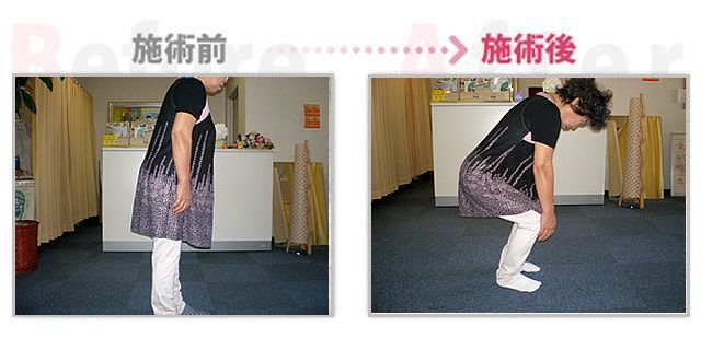 【安城整体カイロ】ぎっくり腰改善。（治療効果：豊田市在住）