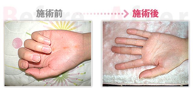 【安城整体カイロ】手の麻痺改善。（治療効果：知立市在住）