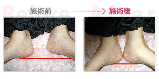 【安城整体カイロ】骨盤ダイエット（治療効果：安城市在住）