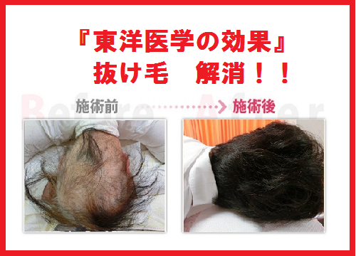 【安城整体カイロ】美容師も通う口コミの多い抜け毛　解消法とは。